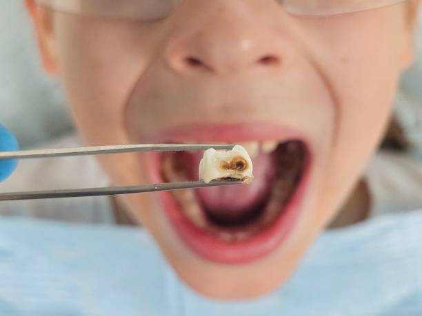 Best Broken Tooth Emergency  in Hamilton, AL